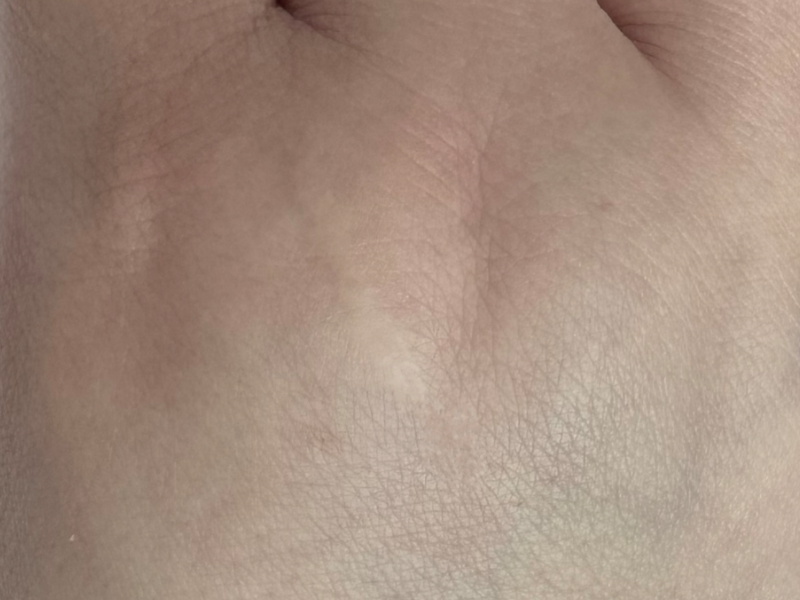 רחלי אחרי צלקת