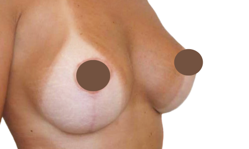 אחרי הרמת חזה