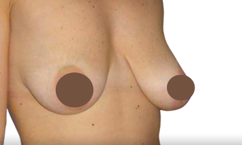 לפני הרמת חזה