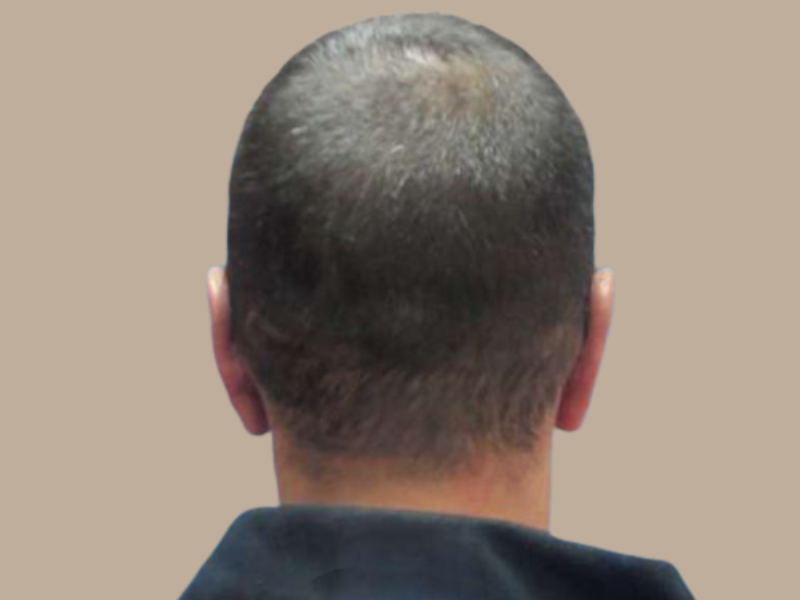 שובל אחרי הצמדת אוזניים