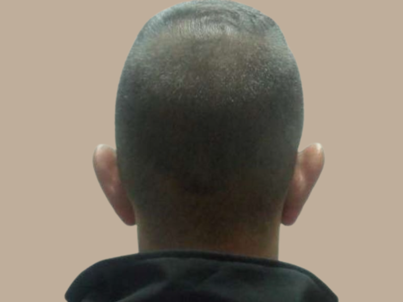 שובל לפני הצמדת אוזניים