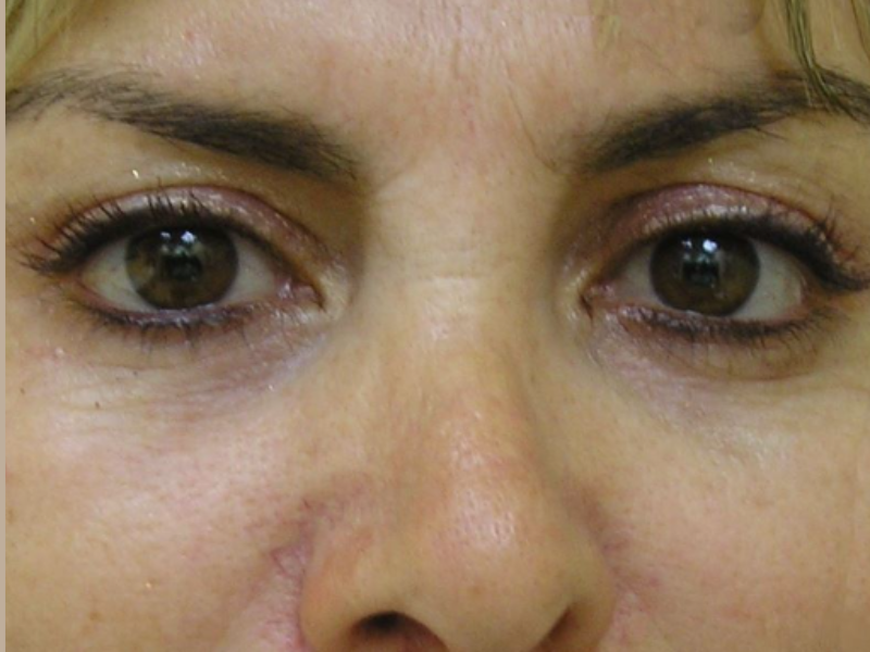 אחרי ניתוח עפעפיים