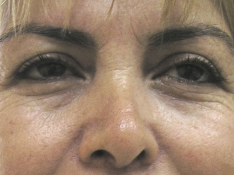 לפני ניתוח עפעפיים