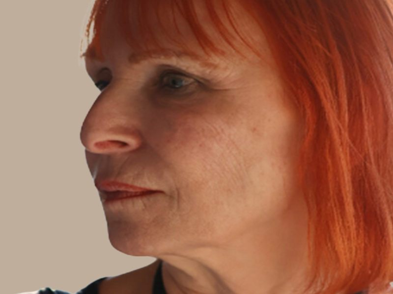 שושנה אחרי חומצה היאלרונית