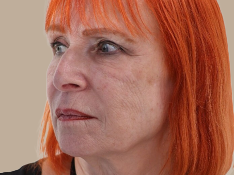 שושנה לפני חומצה היאלרונית