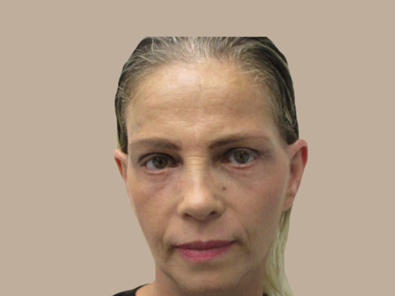 אחרי מתיחת פנים