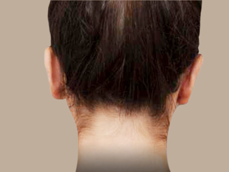 שקד אחרי הצמדת אוזניים