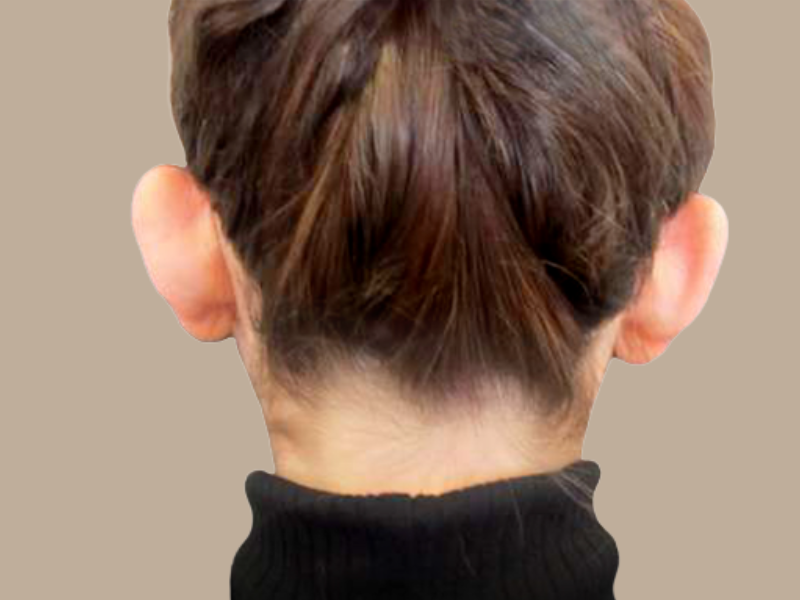 שקד לפני הצמדת אוזניים