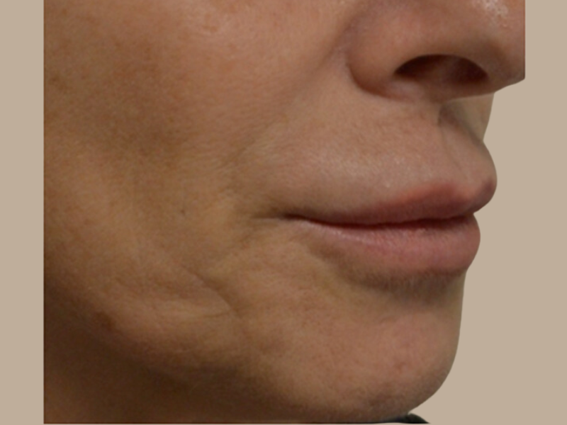 בוסט אנטי אייג'ינג לפני