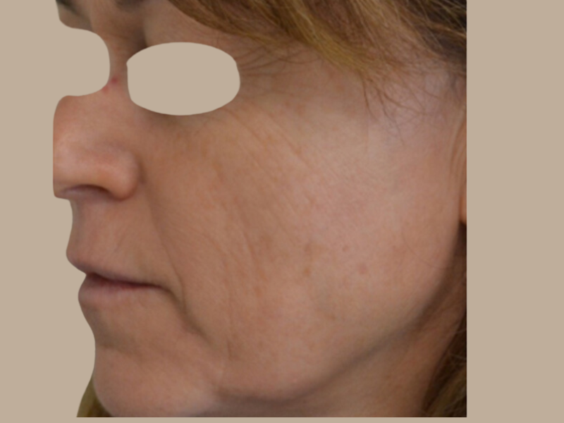 בוסט אנטי אייג'ינג אחרי