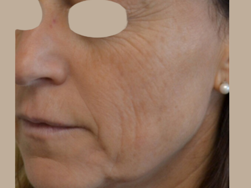 בוסט אנטי אייג'ינג לפני