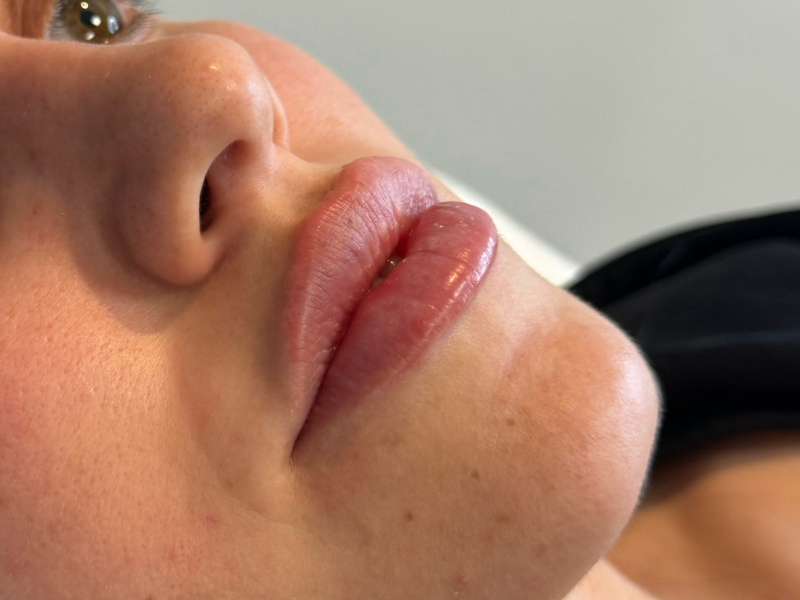 אלין עיבוי שפתים אחרי