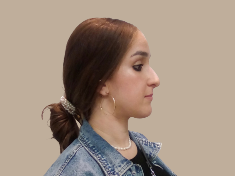 מיכל לפני ניתוח אף